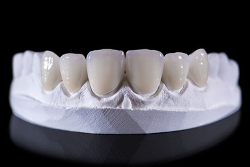 veneer