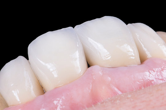 zirconium artificial teeth