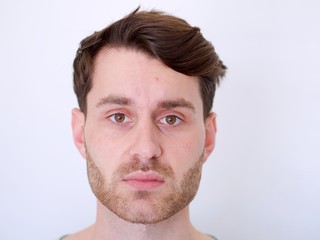 Obraz premium Closeup of a young caucasian man with a pimple on his forehead.