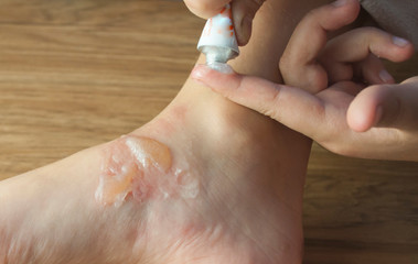 blisters on a child's foot from scalding