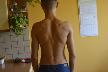 The back of a young athletic boy with mark