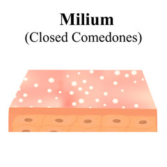 Closed comedones. Acne on the skin. Dermatological and cosmetic diseases on the skin of the face acne. Infographics. Vector illustration on isolated background.