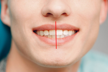 Whitening teeth. Before and after procedure. .Dentistry. Dental clinic. Close up teeth.