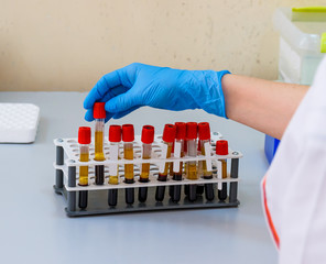 Hands of laboratory assistant in gloves analyzing blood sample. Prevention. Pneumonia diagnosing....