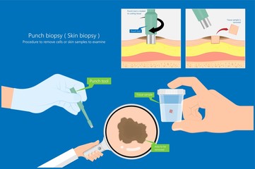 Skin biopsy dermoscope tool surgical diagnose lupus rash cell exam medical Shave Punch dermis layer superficial fat ABCDE rule sign check basal moles treat remove inflammatory tags Warts lab test type