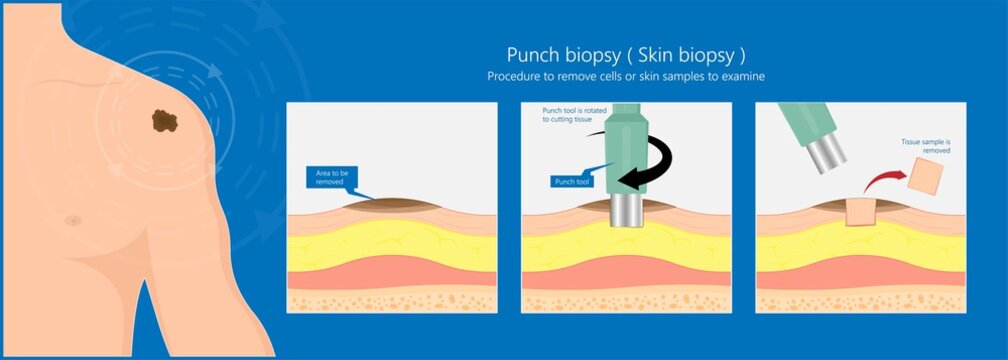 Skin Biopsy Dermoscope Tool Surgical Diagnose Lupus Rash Cell Exam Medical Shave Punch Dermis Layer Superficial Fat ABCDE Rule Sign Check Basal Moles Treat Remove Inflammatory Tags Warts Lab Test Type