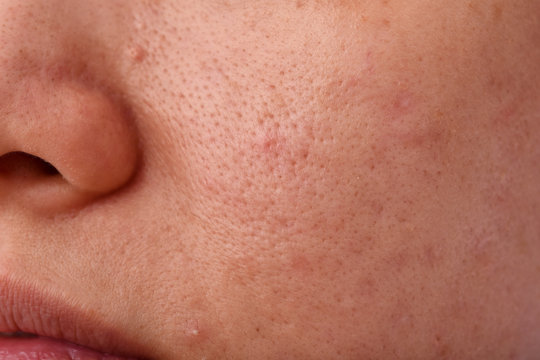 Skin problem with acne diseases, Close up woman face with dry lip mouth, Scar and oily greasy face, Beauty concept.