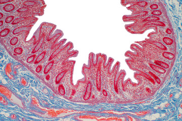 Colon biopsy from the colonoscopy.
