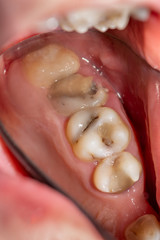 treatment of tooth decay with subsequent filling with photopolymer material. Close-up, macro