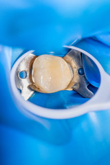 close-up treatment of a human tooth using a blue rabberdam system and a dental mirror. Aesthetic dentistry, hygiene