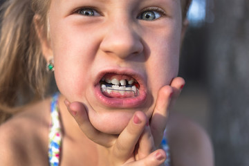 Little girl with orthodontics appliance and crooked teeth. Wobbly tooth.