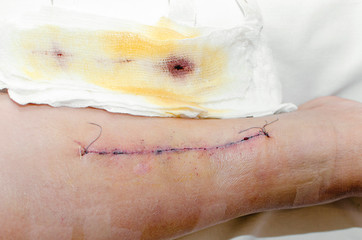 Medical suture on the wound on the leg after surgery.