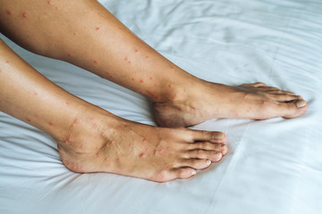 Female legs with many red spot and scar from sand fly bites
