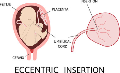 Obraz premium Eccentric insertion of umbilical cord. insertion site varies from the center of the fetal surface to the border of the placenta.