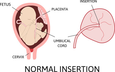 Normal insertion of umbilical cord.  Medical vector illustration