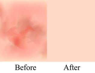 Texture, inflamed pimples and acne. Before After acne cysts. Skin background. Infographics. Vector illustration on isolated background.