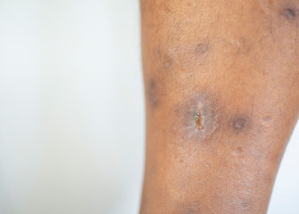 Naklejka premium Wounds that may be infected