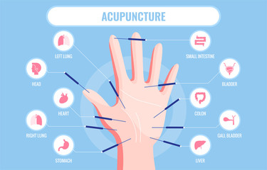 Vector illustration of traditional Chinese acupuncture medicine - obrazy, fototapety, plakaty