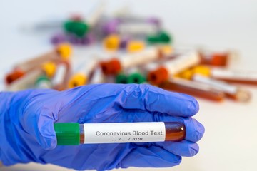 The attendant holds the blood test tube in his hand for corovirus. - 334233025