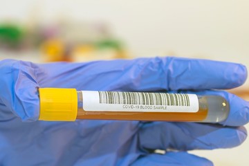 The attendant holds the blood test tube in his hand for corovirus. - 334233045