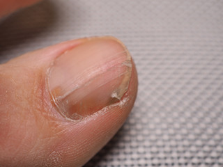Nail infections caused by fungi such as: onychomycosis caused by dermatophytes and yeasts and for the concomitant antibacterial activity