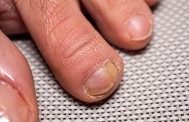 Nail infections caused by fungi such as: onychomycosis caused by dermatophytes and yeasts and for...