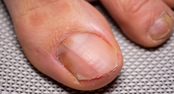 Nail infections caused by fungi such as: onychomycosis caused by dermatophytes and yeasts and for the concomitant antibacterial activity