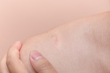 Naklejka premium scar on man back fresh injury