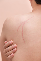 Fototapeta na wymiar scar scratch on man back in accident injury hand touch back pain