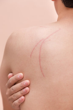 scar scratch on man back in accident injury hand touch back pain