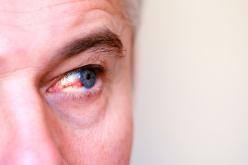 Eye injury. Ophthalmology, burst capillary of the eye.