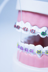 Model denture with metal orthodontics