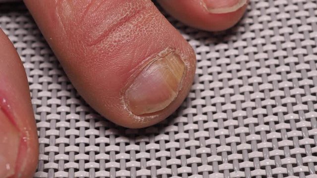 Nail infections caused by fungi such as: onychomycosis caused by dermatophytes and yeasts and for the concomitant antibacterial activity