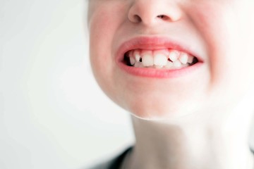 Baby teeth 7 years. Eruption of new permanent teeth. White crooked teeth. Dentistry. Child's jaw. Eruption of incisors.