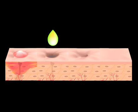 Atrophic Scars. Acne Scar. The Anatomical Structure Of The Skin With Acne. Vector Illustration.