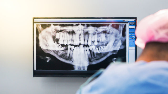 Dental x-ray and dental implant, Panoramic x-ray jaw of the oral cavity with teeth.