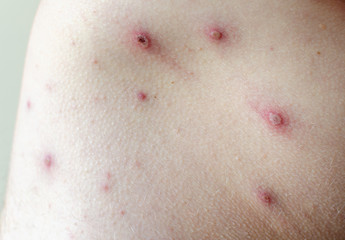 Large spots and pimples acne on the body - adult body with chickenpox. man with Chickenpox,...