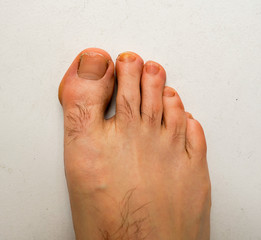 Broken and not healthy human foot nail