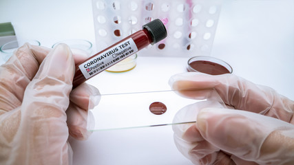 Coronavirus test in lab positive blood work sample. Pandemic outbreak.