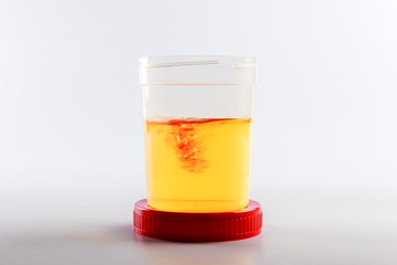 blood in urine analysis as an idea of urogenital system disease and prostate cancer. disease based...