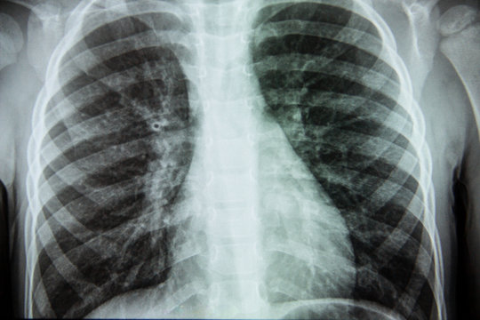 X-ray of a person s lungs with a disease. Screening for coronavirus viruses
