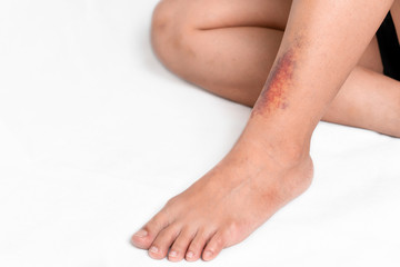 Asian women have bruise on leg from accident on white background.