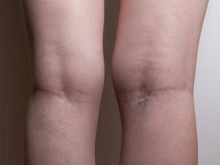 Varicose veins on the legs of a young girl. Reason to see a doctor.