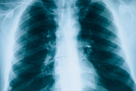 X-rays of lungs. Fluorography. Checking lungs in hospital. Real x-ray human lungs snapshot