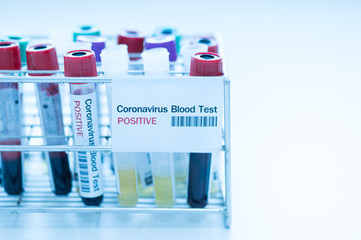 Blood test tube  for laboratory analysis.Laboratory testing patient’s blood samples.Conceptual image coronavirus (COVID-19) test tube sample that has tested positive for coronavirus.