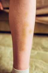 Strong bruised shin - yellow large hematoma on the shin - footballer injury