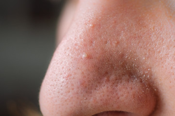 Clogged pores. Problematic skin. Post-acne, scars and red festering pimples on the face of a young man.