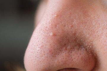 Fototapeta premium Clogged pores. Problematic skin. Post-acne, scars and red festering pimples on the face of a young man.