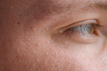 Milia (Milium) - pimples around eye on skin. Eyes of young man with small papillomas on eyelids or growths on skin - obrazy, fototapety, plakaty