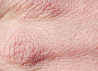 the texture of pink weather-beaten human hand skin covered with deep wrinkles and dry scales